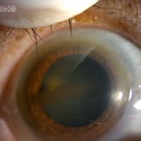 慢性腎病變眼科疾病有增加趨勢患者須注意