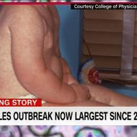 美國麻疹疫情創25年新高 專家：因父母反對接種疫苗