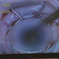 4D技術培養人工角膜 搶救眼疾患者惡視力