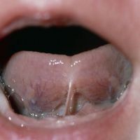 舌繫帶異常哺乳困難 不需手術輔助即可