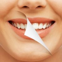 牙齒美白屬醫療行為 由專業合格牙醫師執行安全有保障