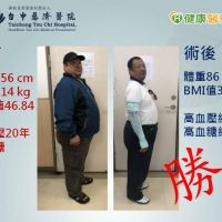 廚師減重失敗變胖大叔　縮胃手術甩24公斤肉