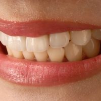 23歲女大生一開口牙骨已流失！ 台灣青年型牙周病多歐美十倍