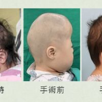 周歲女娃頭型好特別 罕病多條顱縫早閉症所導致