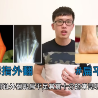 每3個人就有1個有的腳底2大問題？！拇指外翻和扁平足｜阿舟物理治療