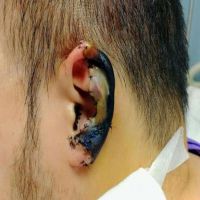 接回失敗！香港區議員耳朵被咬　耳廓壞死