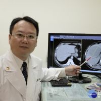 立體定位放射治療　患者9公分巨大肝腫瘤全消失