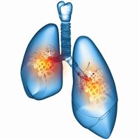 小細胞肺癌6成活不過1年 免疫療法開啟治療新契機