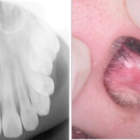 嘴裡「多生牙」長到鼻腔 北榮研究：兒童贅生齒早期拔除莫輕忽