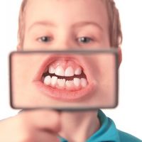 兒童換牙齒列不整齊 及早矯正治療拯救醜小鴨