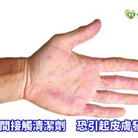 【武漢肺炎】做好防護措施　有效預防接觸性皮膚炎　