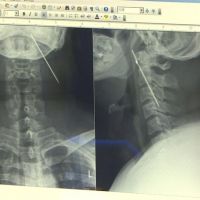 8公分鋼釘人體迷航三年 穿脖直插入左頸內顱骨