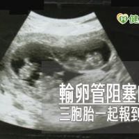 試管嬰兒三胞胎　懷孕過程有驚無險