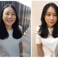 新型女神動態玻尿酸 讓你變的自然青春又亮麗