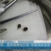 壁蝨叮咬也致命！　中國蜱蟲引發「新布尼亞病毒」感染
