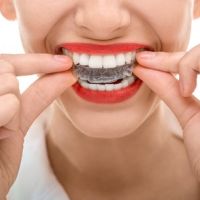 專利SOS美加數位隱形矯正　牙齒矯正更加美觀、精準、省時