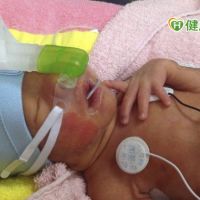 三分之一早產兒呼吸窘迫　呼吸器同步可減少肺損傷