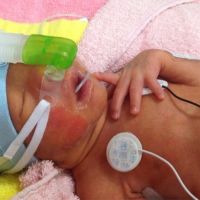 早產兒各項器官發展都未成熟 呼吸是生命第1個關卡！