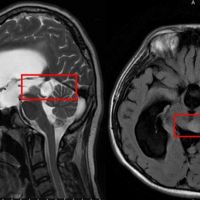 少年頭痛合併眼動異常頻跌倒 水腦併中腦腫瘤是病灶