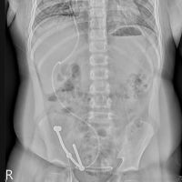 男童腹痛多次就醫治療無效 X光發現腹中竟藏多塊磁鐵