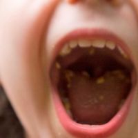 牙齒排列不佳咬合不正 幼兒時期蛀牙容易阻礙恆齒生長