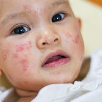 幼兒皮膚反覆搔癢紅疹脫屑 可能是異位性皮膚炎在作怪