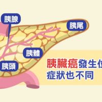 國衛院找出台灣胰臟癌患者雞尾酒療法 可增1倍存活期