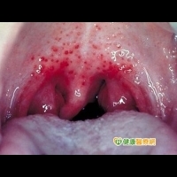 喉嚨發炎紅如生牛肉　恐為A族鏈球菌感染
