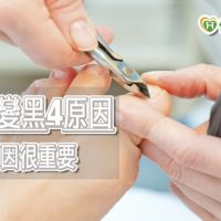 腳指甲變黑別急著拔　醫師揭指甲變黑4原因