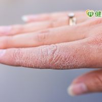 冬季洗手致雙手乾癢怎麼辦？　皮膚科醫師提3重點