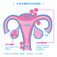 不可輕忽的「子宮內膜異位症」！6大症狀報你知...還有可能造成不孕？！