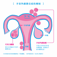 不可輕忽的「子宮內膜異位症」!6大症狀報你知...還有可能造成不孕?!
