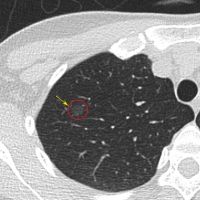 肺癌無痛無感難發現 靠低劑量電腦斷層揪出病灶