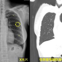 50歲女慢性咳嗽早期肺癌　肺內驚見十顆肺結節