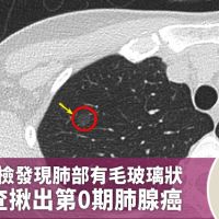 女子健檢發現肺部有毛玻璃狀 這檢查揪出第0期肺腺癌