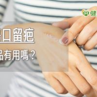 避免傷口留疤　矽膠產品有用嗎？