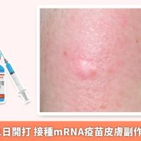 莫德納7月1日開打 接種mRNA疫苗皮膚副作用有哪些？