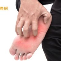 腳癢難受抓不停！　皮膚科醫師教你辨別「香港腳＆汗皰疹」