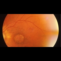 視力大幅減退？黃斑部惹的禍 | 健康達人網