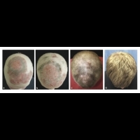 關節炎藥物 成功治療禿髮症男子 | 健康達人網