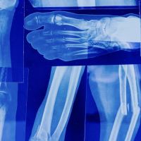 骨鬆也有三級警戒！ 一旦發生髖關節骨折一年內死亡率破20%