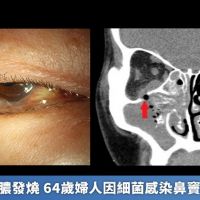 右眼腫痛流膿發燒 64歲婦人因細菌感染鼻竇炎差點失明