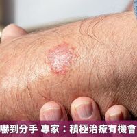 乾癬讓女友嚇到分手 專家:積極治療有機會讓病灶清零