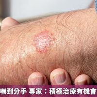 乾癬讓女友嚇到分手 專家：積極治療有機會讓病灶清零