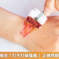 傷口該不該縫合?打不打破傷風? 正確照顧傷口不留疤