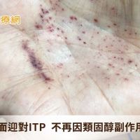 66歲婦正面迎對ITP 不再因類固醇副作用問題卡關