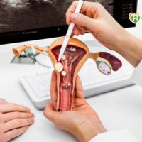 子宮肌瘤合併卵巢瘤　「單孔腹腔鏡微創手術」解困擾