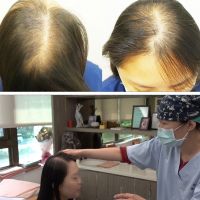 女性落髮Q&amp;A   輕植髮女子專科門診 　一站式服務
