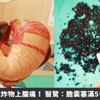 百斤男嗜吃炸物上腹痛! 醫驚:膽囊塞滿5千顆膽結石