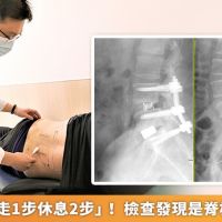男下背痛「走1步休息2步」! 檢查發現是脊椎脫滑惹禍